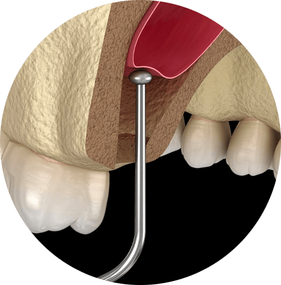 sinus lift graphic