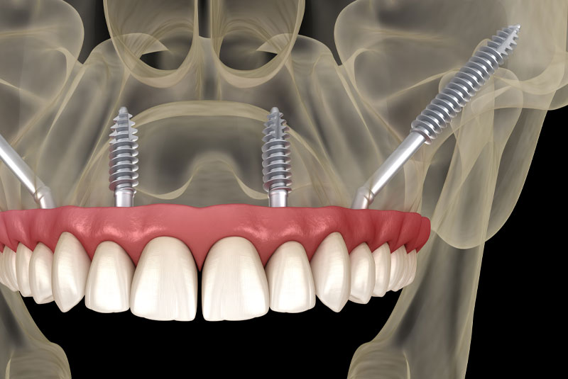 zygomatic dental implant modell