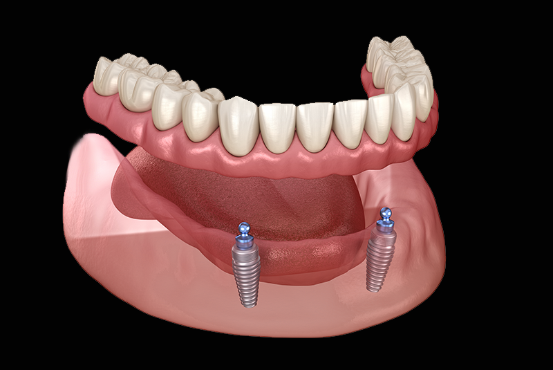 implant denture