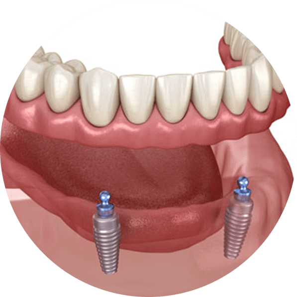 implant supported dentures