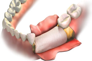 jawline skin being pulled back to show the underlying bone graft.