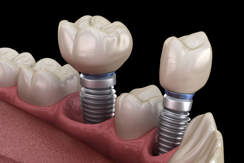 https://www.bigskysmilecenter.com/wp-content/uploads/2023/04/dental-implants-model-2.jpg?utm_source=chatgpt.com