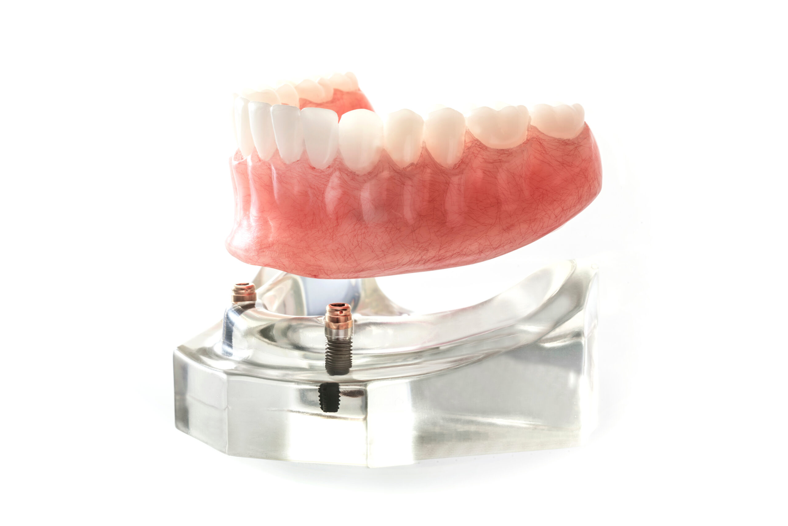 an image of an implant supported denture.