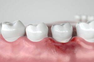 3d image of tooth model wuth gum disease