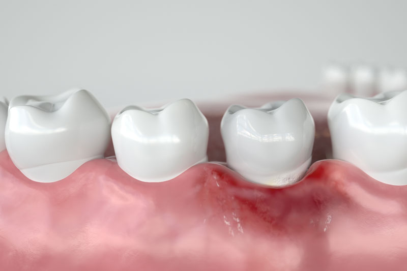3d image of tooth model wuth gum disease