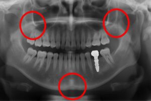 Worried about dental implant complications? This image shows an x-ray of a jaw with a dental implant, highlighting potential problem areas like the sinus cavity and nerve locations. No text on the image.