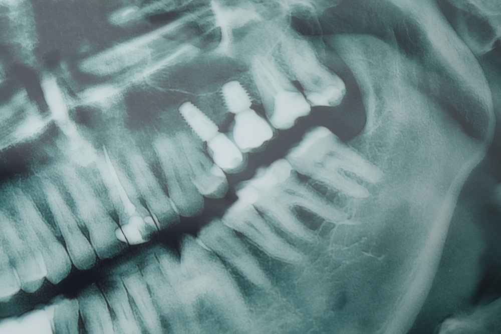 A collage of screenshots from various websites and social media platforms, displaying a diverse range of "implant teeth reviews" from different patients. The images should highlight both positive and negative feedback, with star ratings and written testimonials visible. No text on image.