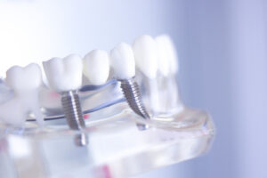 Dentist consulting with a patient about dental implants in a modern clinic
